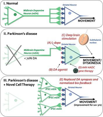 Advantages and Recent Developments of Autologous Cell Therapy for Parkinson’s Disease Patients